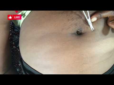 ASMR STOMACH PICKING AND INGROWN HAIR EXTRACTION FOR DEEP SLEEP - RELAXATION GAURANTEED