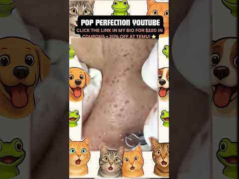 Wow! #pimpleremoval #pimple #pimples #shortsfeed #shortvideo #shorts #short #youtube #youtubeshorts