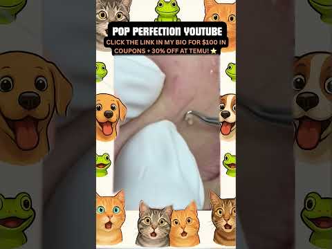 Wow! #pimpleremoval #pimple #pimples #shortsfeed #shortvideo #shorts #short #youtube #youtubeshorts