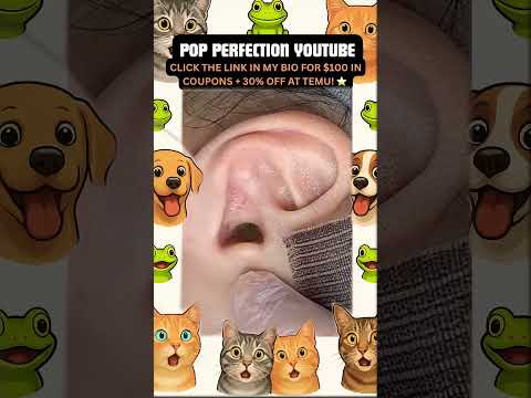 Wow! #pimpleremoval #pimple #pimples #shortsfeed #shortvideo #shorts #short #youtube #youtubeshorts