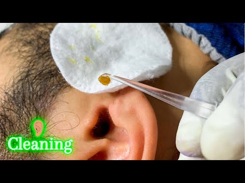 HUGE Ear Wax Removal ~ Cleaning Triggers ~ gentle wiping sleep sounds.