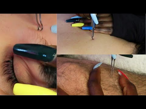 {100K 😃} Full Body Nitpicking Whiteheads 1HR | zoomed •back •face •hands •legs {ASMR}