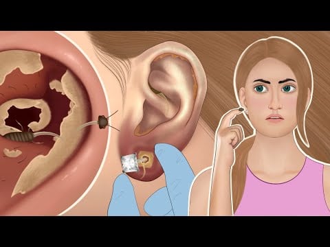 ASMR ear cleaning|| ear wax removal|| ASMR animation|| #asmr #animation