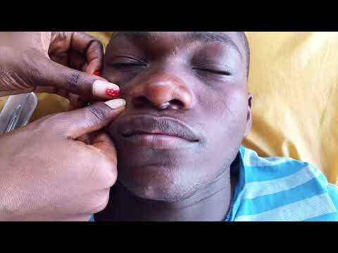 Asmr whiteheads and blackheads removal