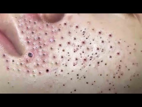 SATISFYING AND RELAXING PIMPLE POP COMPILATION | PART 27