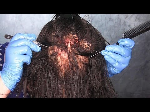 ASMR Scalp Check with Bad Results (Dry Skin Removal, Dandruff Removal, Scalp Treatment) Medical RP