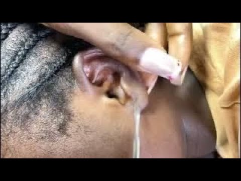 ASMR EAR CLEANING SCALP SCRATCHING,  GUM CHEWING, FACE PICKING AND TAPPING