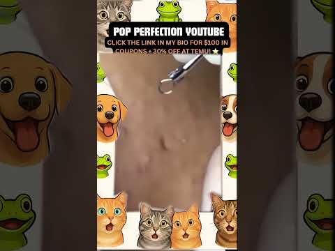 Wow! #pimpleremoval #pimple #pimples #shortsfeed #shortvideo #shorts #short #youtube #youtubeshorts