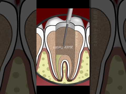Dental decay restoration, Teeth cleaning, cavity treatment animation,#animation#trending#asmr#teeth