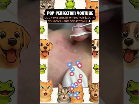 Wow! #pimpleremoval #pimple #pimples #shortsfeed #shortvideo #shorts #short #youtube #youtubeshorts