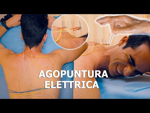 ASMR: HO PROVATO L' AGOPUNTURA CINESE con SCARICHE ELETTRICHE!