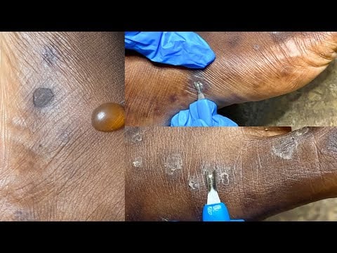 Asmr Another Huge Blackheads luxury &Nitpicking Treatment, Skincare