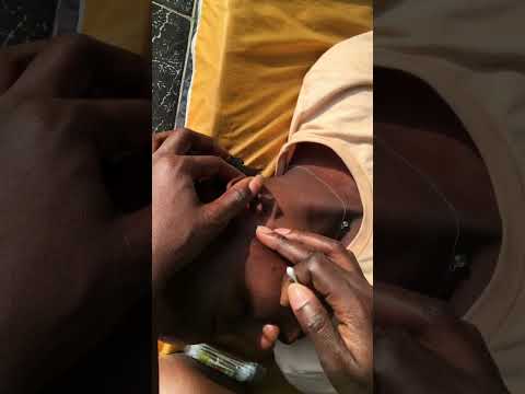 Face nitpicking pimples #satisfying #nitpicking #oddlysatisfying #asmrcommunity #asmr