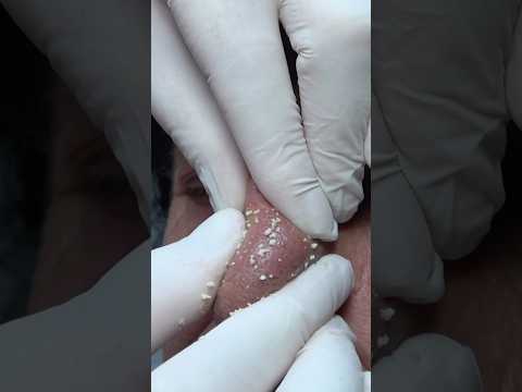 BARBER FACE AND NOSE OIL REMOVAL - MASSAGE - CRACKS #asmracmp #massage #barber #sleep #relax #masaj