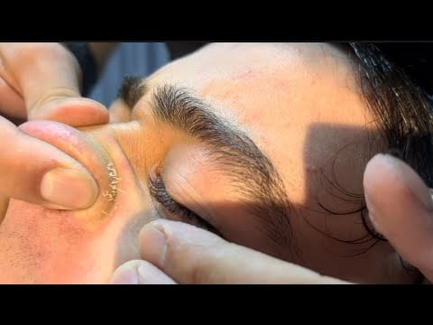 Secret Acne treatment and ASMR Barber Massage