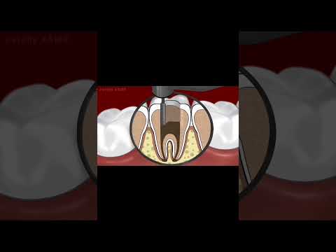 dental decay restoration animation||#asmr #asmranimation #asmrvideo #animation #stopmotionanimation