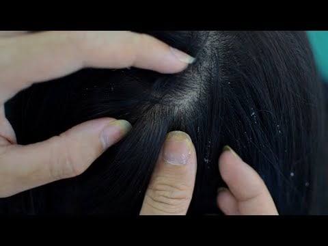 ASMR Scalp Picking, Scalp Check, Scalp Scratching, Lice Check Relaxing For Sleep