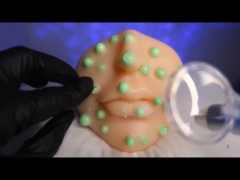 Compilado ASMR de Cravos GIGANTES! 🎧 As Extrações Mais Satisfatórias