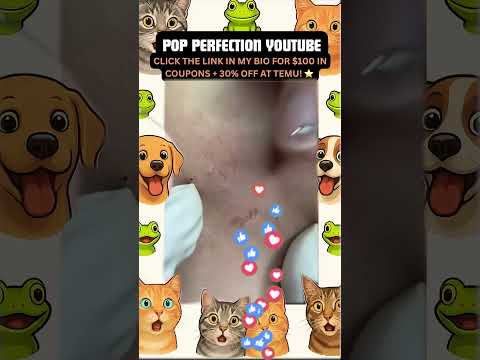 Wow! #pimpleremoval #pimple #pimples #shortsfeed #shortvideo #shorts #short #youtube #youtubeshorts