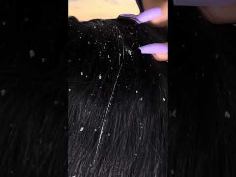 Dandruff removal 💆🏻‍♀️🫨 #tingles #satisfying #asmr #shorts #scratch #asmrhairplay