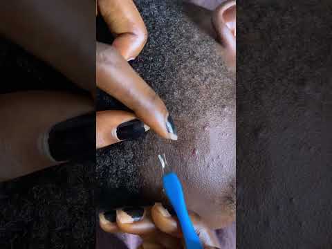 Face Nitpicking asmr #asmr #satisfying #sleepsounds #tinglyfeeling #relax #tingling #nitpicking