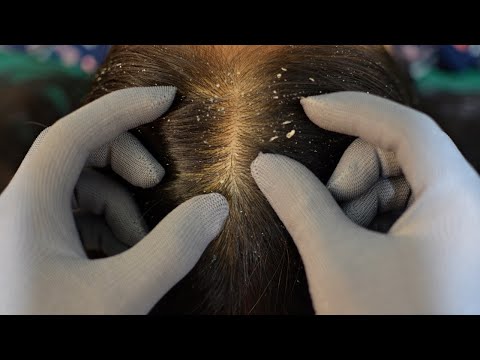 ASMR Scalp Check, Scalp Scratching With Gloves Relaxing For Sleep ( No Talking )