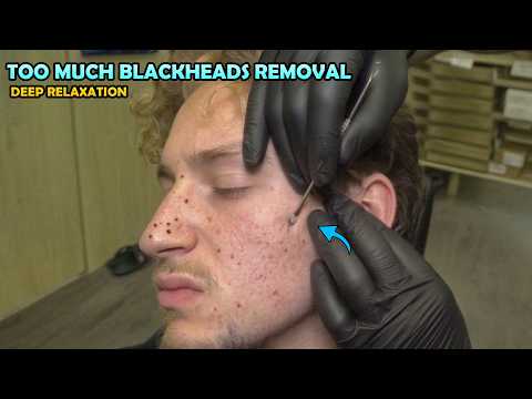 💈 I REMOVED A LOT OF BLACKHEADS + CRACKS + ASMR head,chest,belly,armpit,back,face,ear,neck massage