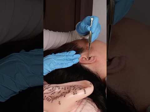 ASMR Ear Seeds Therapy, Ear Acupressure, Ear Cleaning, Scalp Massage #relax #satisfying #earmassage