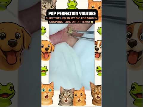 Wow! #pimpleremoval #pimple #pimples #shortsfeed #shortvideo #shorts #short #youtube #youtubeshorts