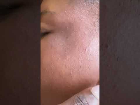 Face Nitpicking Asmr #tingling #satisfying #asmr #nails #ear #skincare