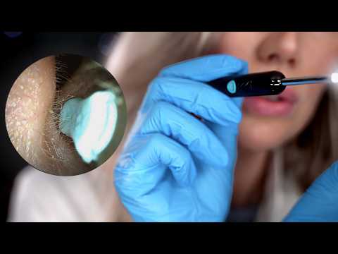 Close-Up ASMR | Deep Ear Exam (actual ear footage with wax removal)
