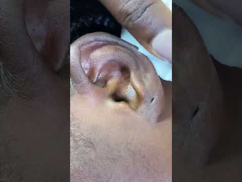 ASMR EAR CLEANING AND NITPICKING #asmr #satisfying #tingling #relax #asmrvideos
