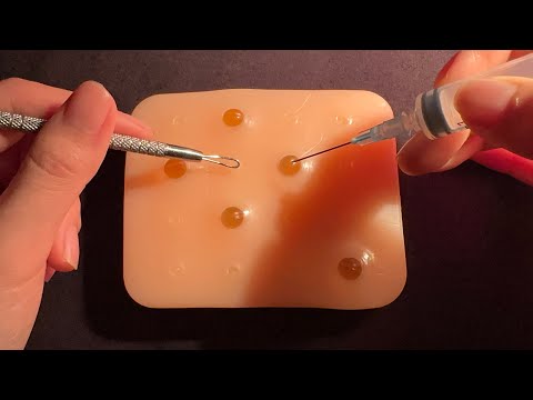 시각적 팅글 미쳐버린👀 피부과 압출 ASMR 롤플레이 visual trigger pimple popping roleplay