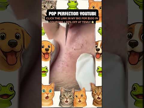 Wow! #pimple #pimples #pimplepopping #shortsfeed #shortvideo #shorts #short #youtubeshorts #youtube