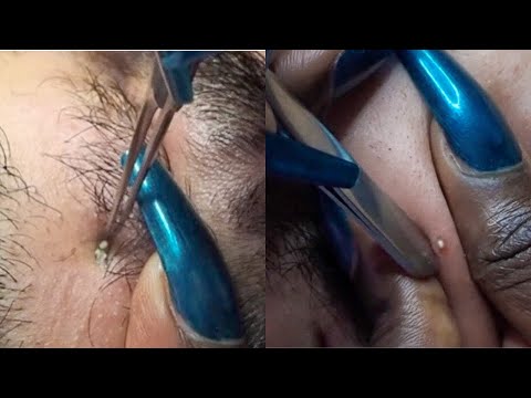 ASMR Face Picking EXTRACTIONS in new Camera {allzoomed} |  Extremely satisfying