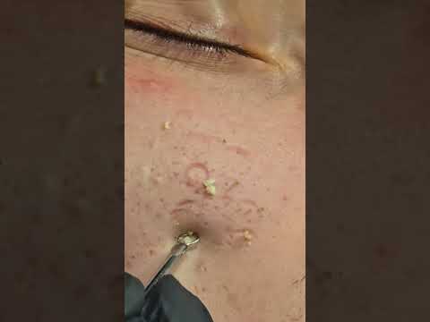 NO ADS 🚫 The Most Relaxing Blackhead & Acne Treatment Ever (ASMR) #acne #blackheads