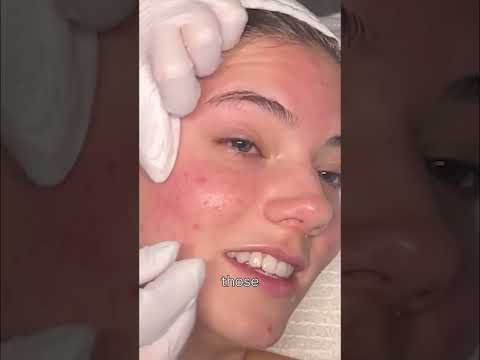 Satisfying Pimple Pop: HUGE Blackhead EXPOSED! #shorts