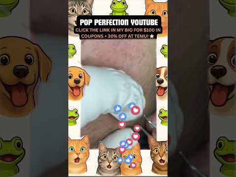 Wow! #pimpleremoval #pimple #pimples #shortsfeed #shortvideo #shorts #short #youtube #youtubeshorts