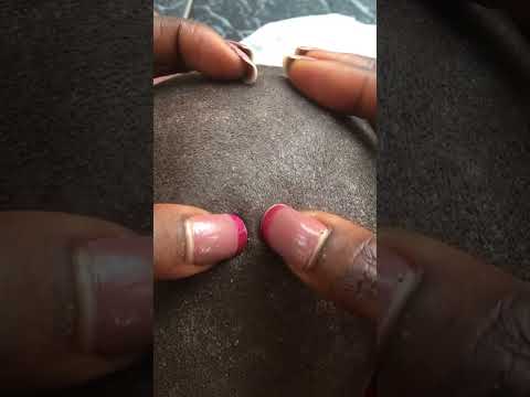 Oiling And Scratching off dandruff on a bald scalp #tingling #asmr relaxing #nitpicking #dandruff
