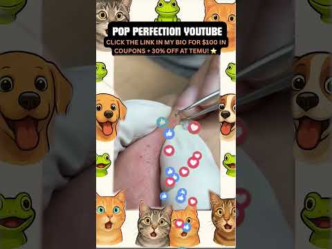 Wow! #pimpleremoval #pimple #pimples #shortsfeed #shortvideo #shorts #short #youtube #youtubeshorts