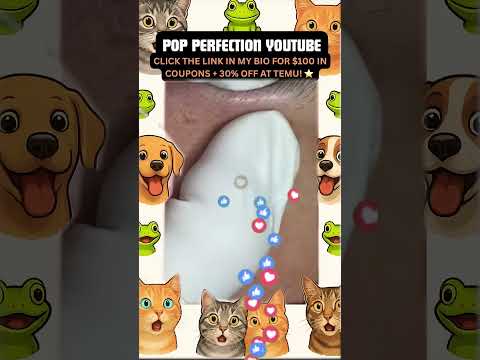 Wow! #pimpleremoval #pimple #pimples #shortsfeed #shortvideo #shorts #short #youtube #youtubeshorts