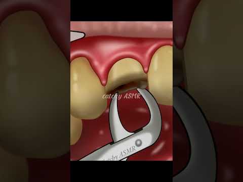 ASMR damage tooth extraction|| gold teeth implant|| dental decay treatment animation|| #asmrsounds