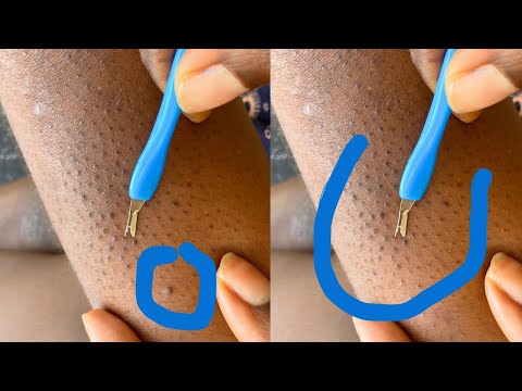 ASMR LEG NITPICKING SO SATISFYING