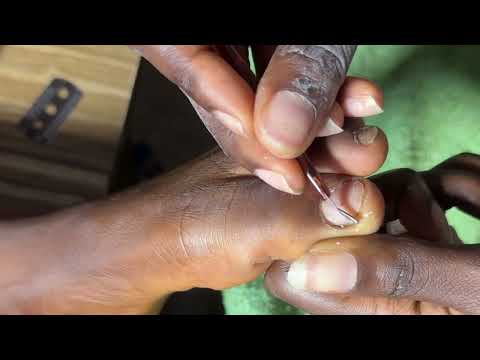 ASMR FOOT/LEG MASSAGE, INGROWN TOENAILS REMOVAL, PEDICURE, FOOT/LEG SCRATCHING, GUM CHEWING