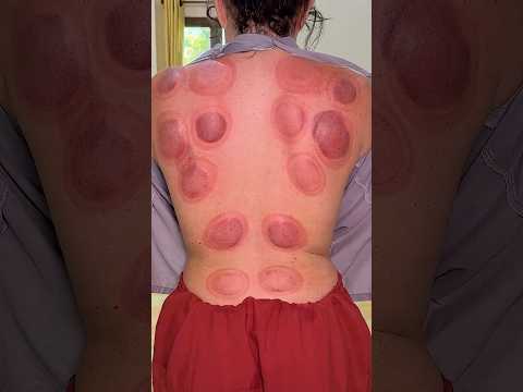 ASMR Chinese FIRE CUPPING Massage & GUA SHA for Deep Sleep