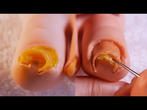 😱 살을 파고든 내성발톱 양쪽 발 관리 + 각질, 보습 케어｜쿰쿰 관리실 상황극 ASMR｜편안한 관리실 배경음악