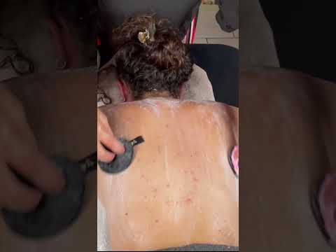 ASMR: Back ACNE Removal Treatment at Home! #shorts #asmrmassage #asmr  #backmassage #acneremoval