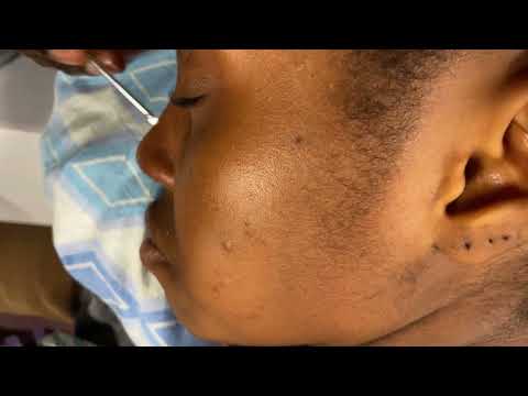 ASMR EAR PICKING, SCALP SCRATCHING, BACK NITPICKING FOR SLEEP WITH GUM CHEWING