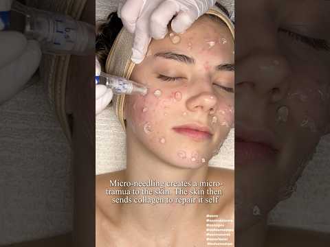 ASMR Facial Microneedling on ​⁠@katemariess