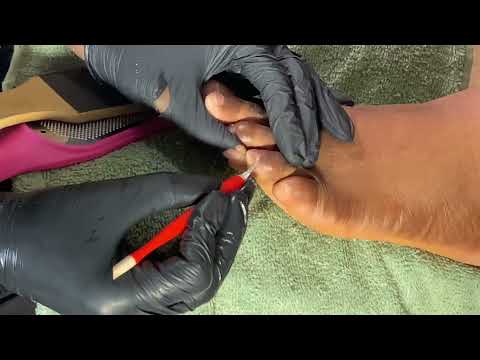 ASMR FOOT MASSAGE AND RELAXING PEDICURE, CORN REMOVAL AND NAILS CUTTING VERY RELAXING